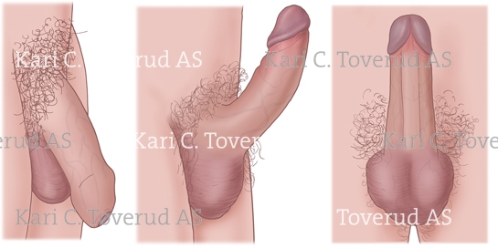 pictures uncircumsized penis